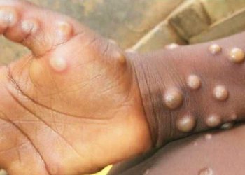 Confirman primer caso importado de viruela del mono en Uruguay  