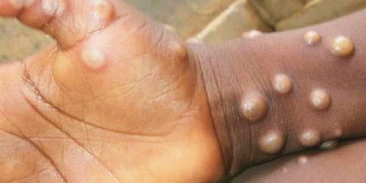 Confirman primer caso importado de viruela del mono en Uruguay  