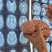 Avanza vacuna personalizada contra el tumor cerebral más letal