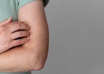 Se confirmó un cuarto caso de sarampión en San Javier