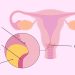 En el mes de la prevención, charla sobre cáncer de cuello uterino apoyada por la dirección de salud