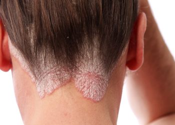 Psoriasis, mucho más que una afección en la piel: especialistas alertan sobre los mitos que siguen perjudicando a los pacientes